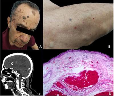 Blue Rubber Bleb Nevus Syndrome With Multiple Cavernoma-Like Lesions on MRI: A Familial Case Report and Literature Review